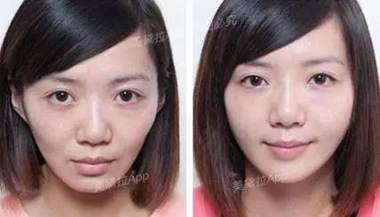 法令纹是填充好还是做筋膜提拉好,法令纹深提拉还是填充好