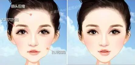 法令纹是填充好还是做筋膜提拉好,法令纹深提拉还是填充好