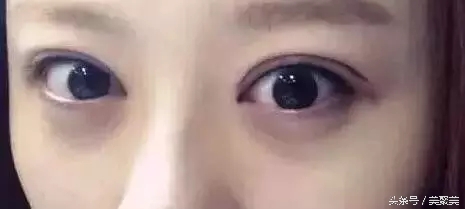 Ta竟然能媲美整形的开眼角？