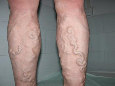 中医治疗精索静脉曲张药方,下肢静脉曲张的中西医治疗