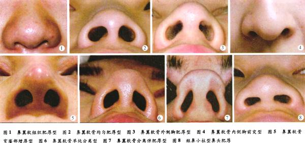 大鼻头整形手术有哪些方法,鼻头鼻翼缩小手术方法