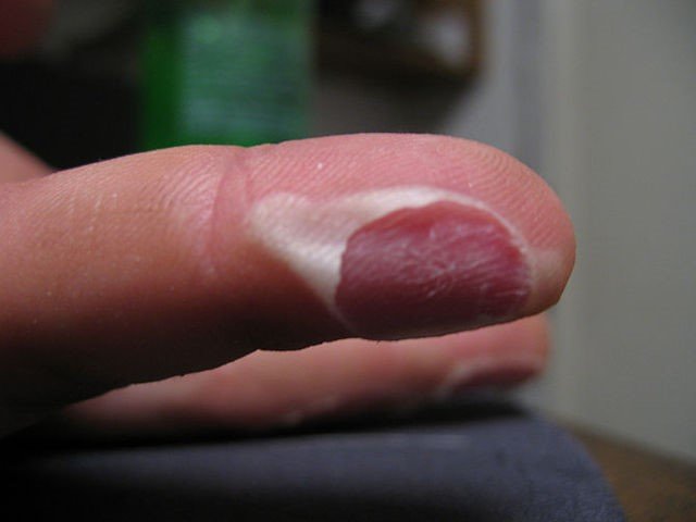 被火烧伤后急救,烧伤急救五部曲