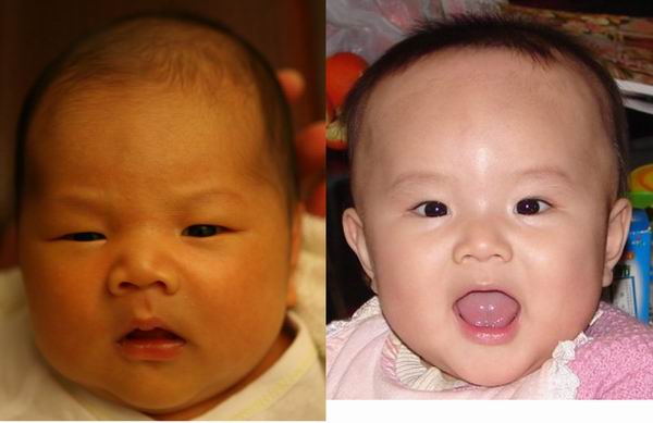 新生儿黄疸有哪些症状多久能退,新生儿黄疸一般出现哪几天