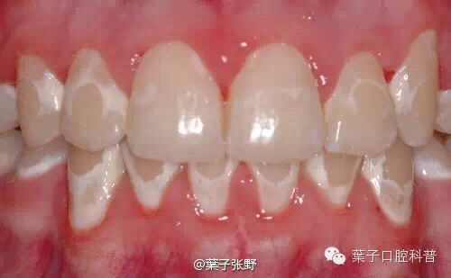 蛀牙怎样才能控制住不再有蛀牙,蛀牙不严重用什么药