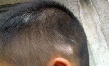 治疗白癜风中草药大全,中药治疗白癜风靠谱吗多久见效