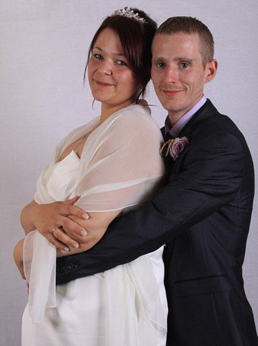 过快减肥的坏处,过快减肥导致脾大