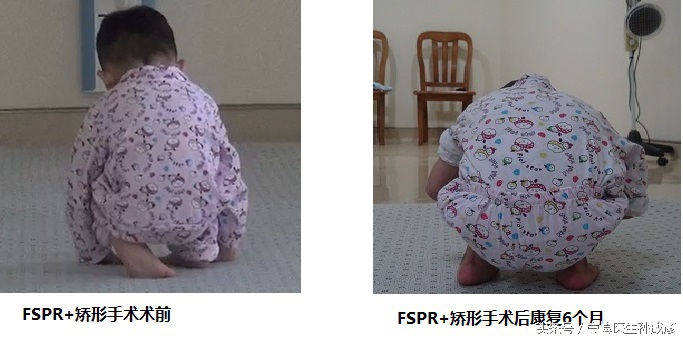 脑瘫导致肢体畸形矫正手术,脑瘫马蹄足矫形手术最新案例