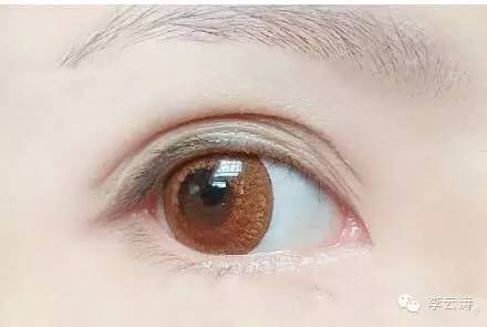 双眼皮18天消肿方法,贴双眼皮教程三眼皮