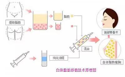 法令纹是填充好还是做筋膜提拉好,法令纹深提拉还是填充好