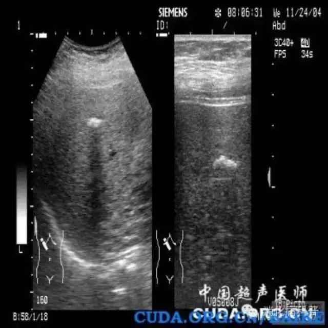 肝内钙化灶需要治疗吗,肝内胆管结石或钙化灶该怎么治疗