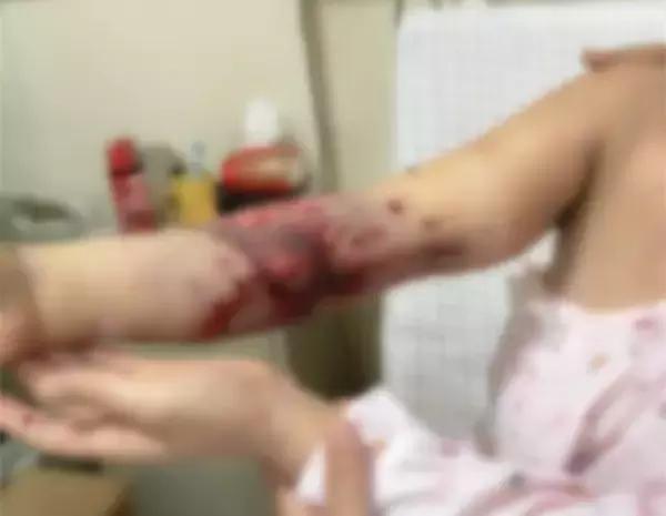 这只被车子压得“稀烂”的手是如何被修补起来的