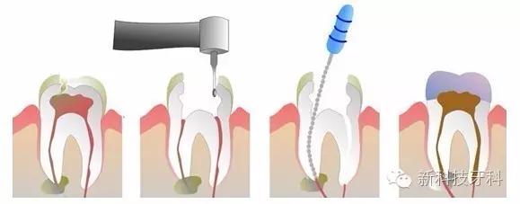 牙科手术注意事项,牙科打麻醉注意事项