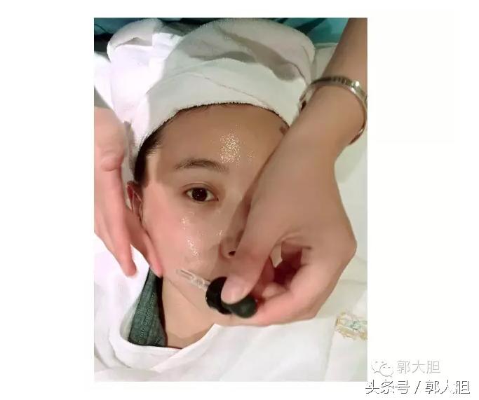 当你以为抗老还要靠超声刀的时候，我去打了更牛X的热拉提