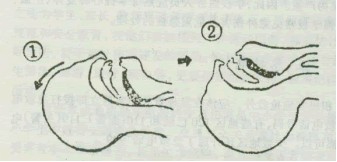 冠心病急救措施最佳方法,冠心病突发处理流程图