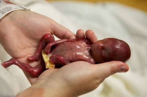 美国早产率最新统计,美国孕妇早产率