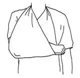 腿部骨折急救方案,骨折的现场急救