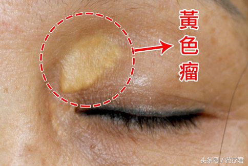 眼睑处有黄色瘤可以恢复吗,眼睑黄色瘤的危害
