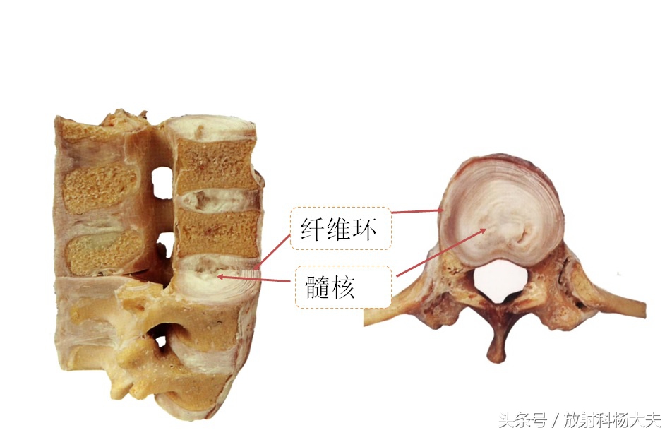 除了腰间盘突出还有什么导致腰疼,除了腰间盘突出别的都不突出