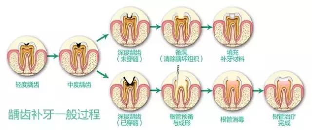蛀牙怎样才能控制住不再有蛀牙,蛀牙不严重用什么药