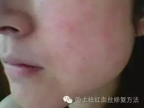 皮肤过敏如何日常修复,皮肤粘胶带过敏用什么方法不过敏