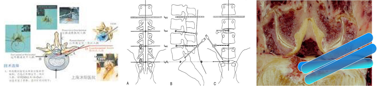 微创手术治疗腰椎间盘突出成功率,目前最热门腰椎微创技术椎间孔镜