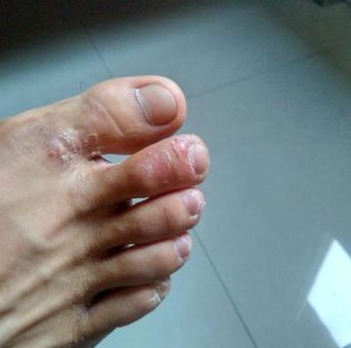 分享给大家几个治脚气小妙招,学会一招足够用