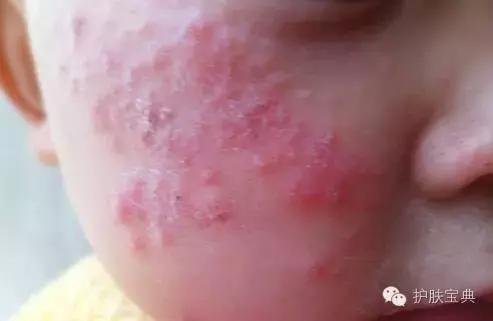 有螨虫的皮肤该怎么处理,螨虫真的和皮肤没有关系吗