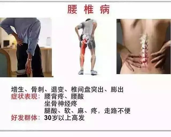 得了腰椎间盘突出怎么治疗,腰椎间盘突出怎么办教你一招搞定