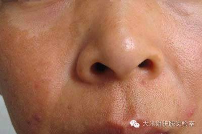 怀孕变老如何预防,孕妇妊娠斑护肤