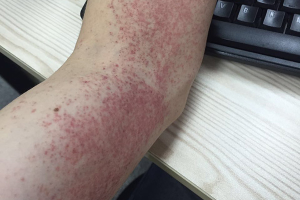 皮肤湿疹瘙痒用什么中药,湿疹瘙痒难忍中医外敷