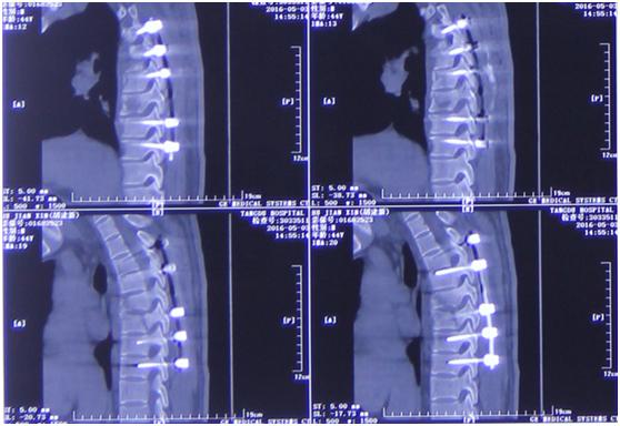 病例压迫神经康复视频,脊髓损伤康复分享