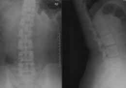 微创手术治疗腰椎间盘突出成功率,目前最热门腰椎微创技术椎间孔镜