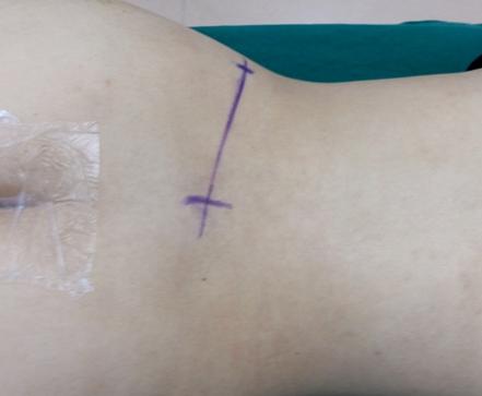 微创手术治疗腰椎间盘突出成功率,目前最热门腰椎微创技术椎间孔镜