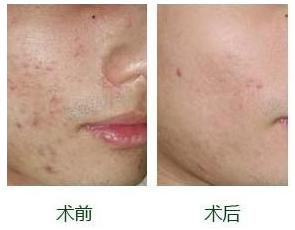 油性皮肤长痘痘用什么药,经常长痘痘经常出油还有痘印