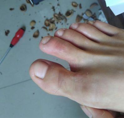 分享给大家几个治脚气小妙招，学会一招足够用