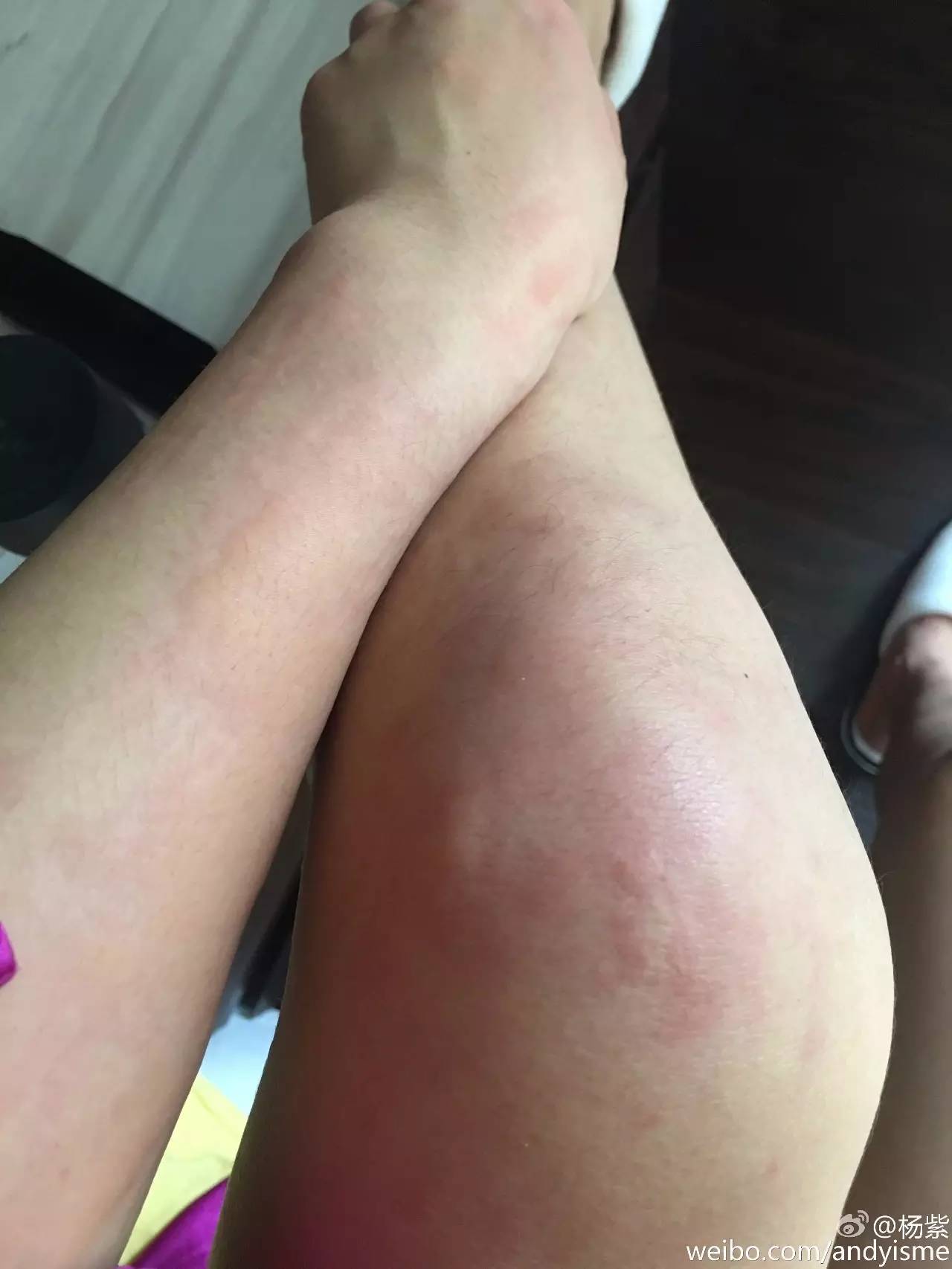 杨紫自爆过敏严重似毁容,难道她的护肤品是假货?