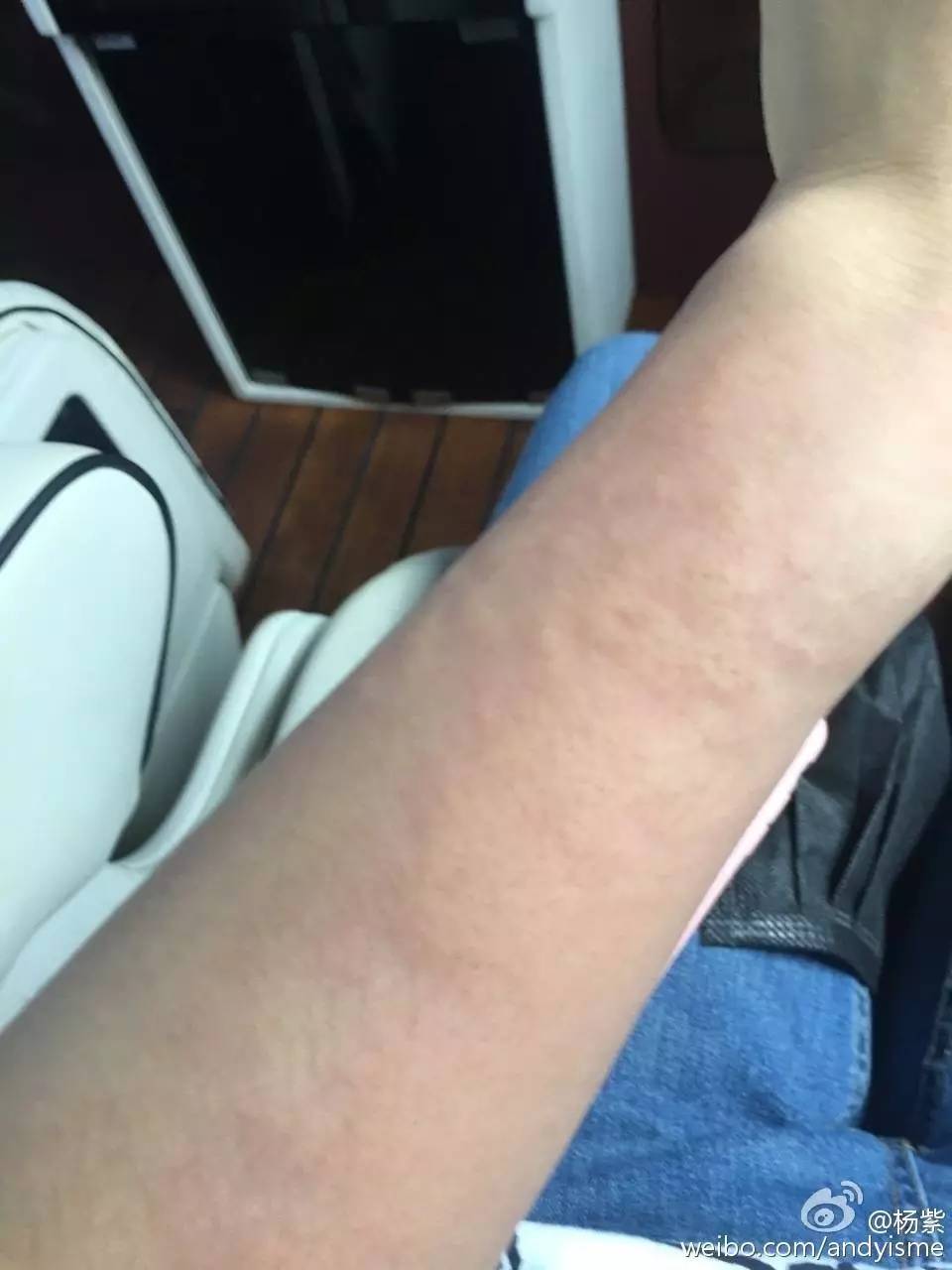 杨紫自爆过敏严重似毁容,难道她的护肤品是假货?