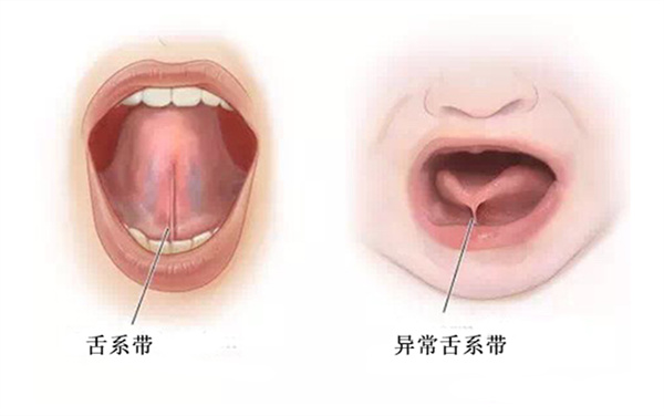 宝宝w型舌1岁半,宝宝w型舌中医辨证