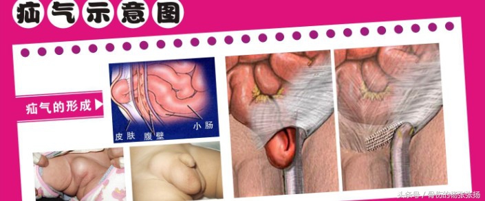 如何预防疝气手术后复发,怎样避免疝气手术后复发