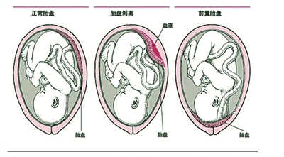 胎盘前置可以顺产吗,孕妇胎盘前置状态怎么办