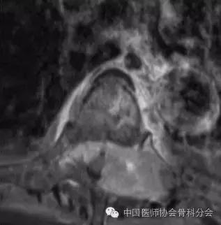 骨科经典案例分享,骨科微创实例