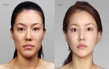 下颌角决定自己的颜值,下颌线决定颜值