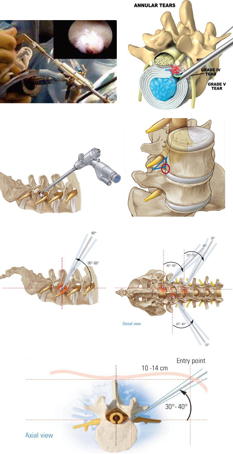 微创手术治疗腰椎间盘突出成功率,目前最热门腰椎微创技术椎间孔镜