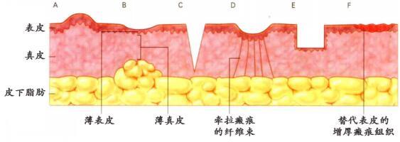 疤痕修复手术有哪些适应症,手术疤痕修复全过程
