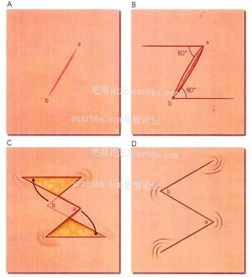 疤痕修复手术有哪些适应症,手术疤痕修复全过程