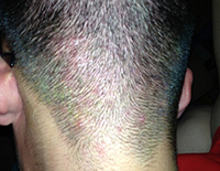 头皮有毛囊炎不能染发和烫头吗,头皮毛囊炎与染发症状的照片