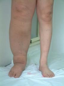 90后演员徐婷去世原因,演员徐婷淋巴癌症状