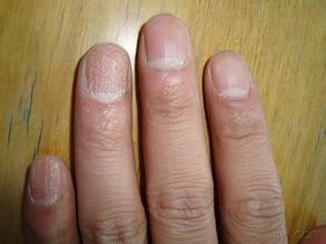 做过指甲后指甲变得坑坑洼洼,指甲突然坑坑洼洼的怎么回事