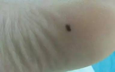 痣该不该祛,有痣需要去掉吗