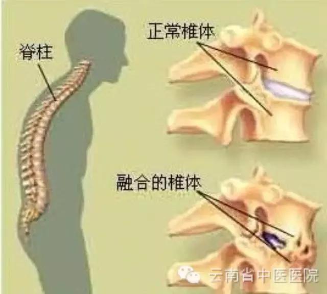 来来来，一起聊聊强直性脊柱炎